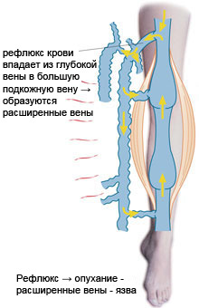 Reflux