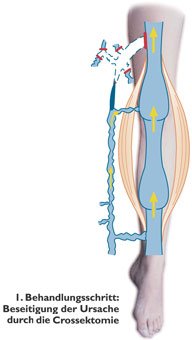 Behandlungsschritt 1